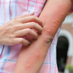 When does mosquito season start in North Texas — and when should you start protecting your yard?